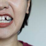 How to Bring Back Your Smile After Tooth Loss