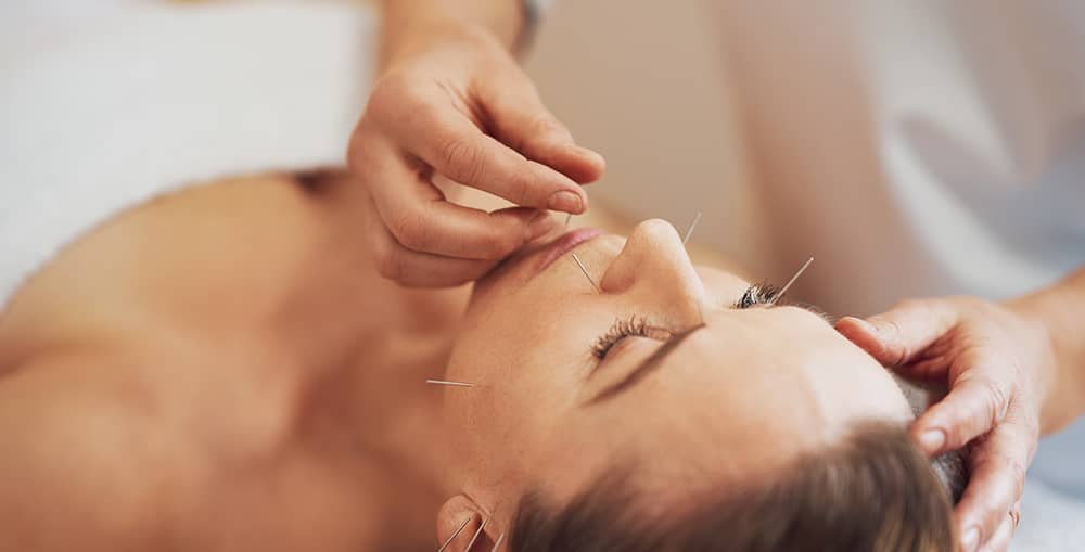 Acupuncture