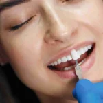 Advanced Dental Veneers Technology Redefines the Art of a Perfect Smile