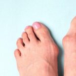 Treating Bunions