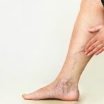 Varicose Veins During Pregnancy
