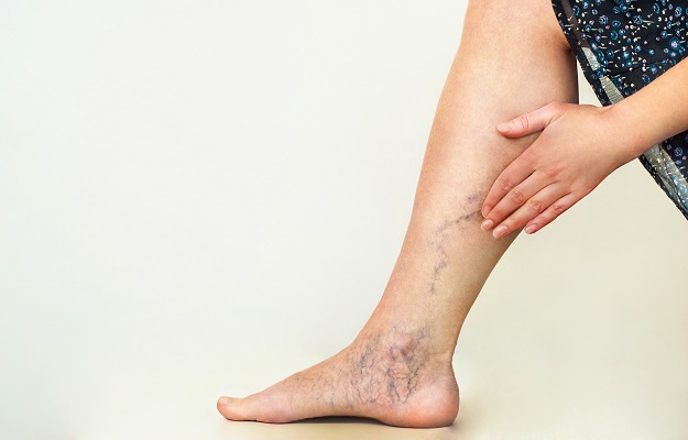 Varicose Veins During Pregnancy